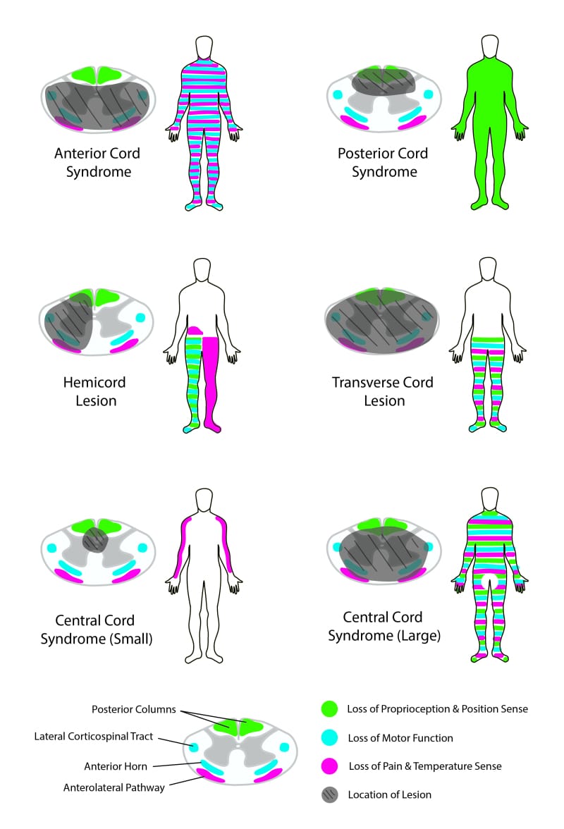 Image from: A Journey Through Spinal Cord Injury