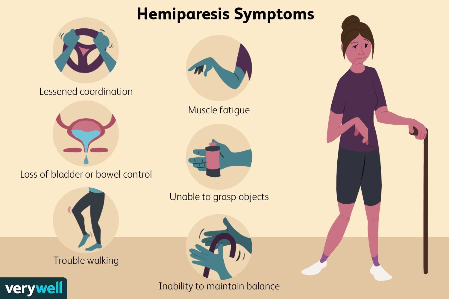 Image from: Hemiparesis (Stroke)