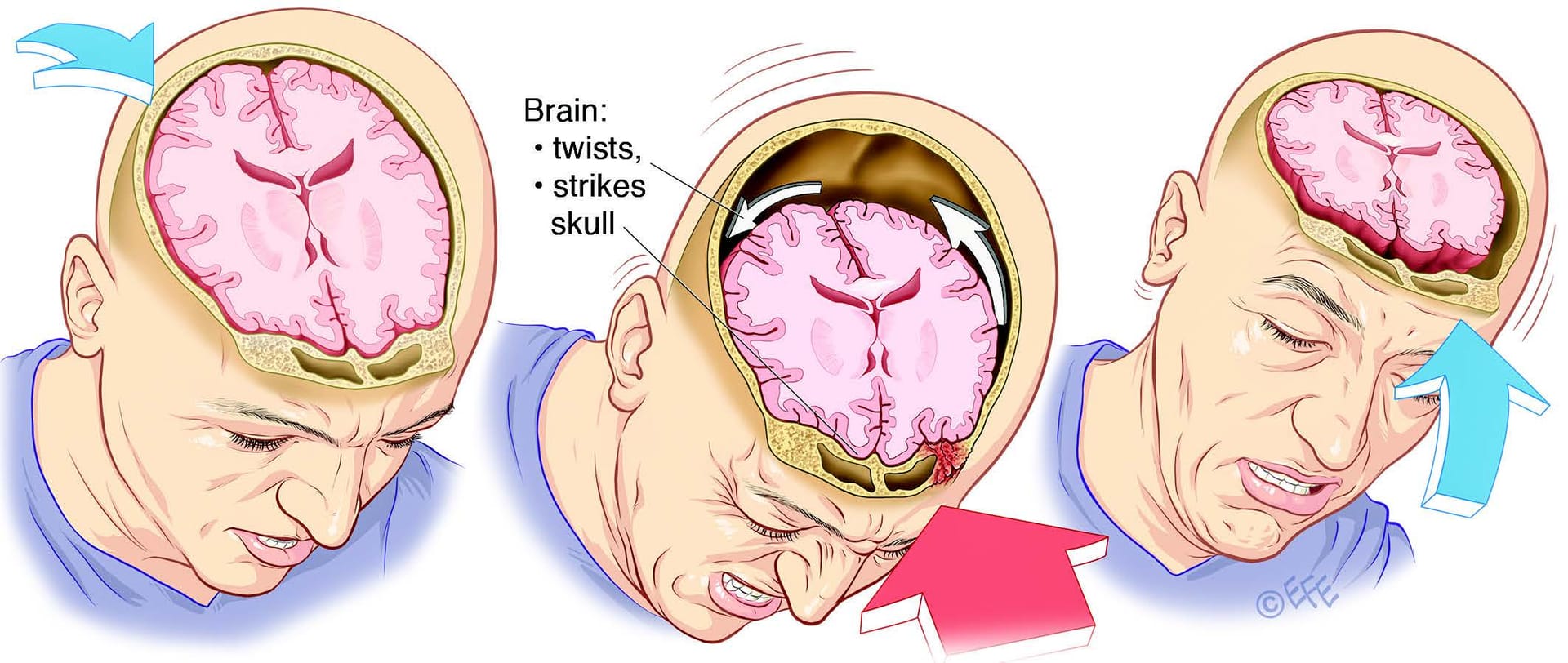 Image from: Concussion 🤕🧠