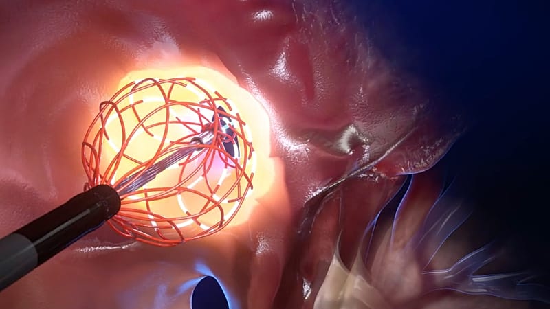 Deep inside the heart: the innovative catheter designed to ...